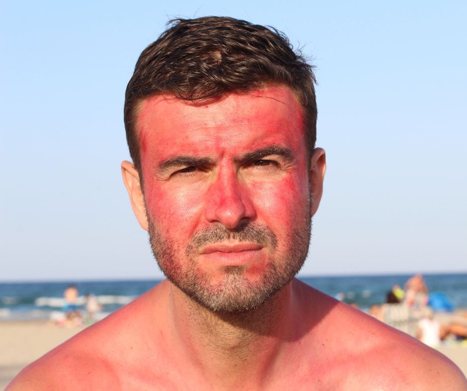 Man with sunburn